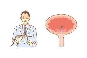ボツリヌス毒素膀胱壁内注入療法とは?